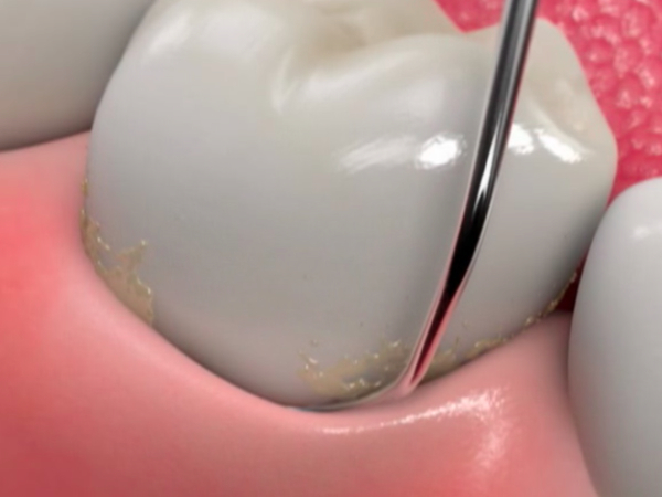 Как работает ультразвуковая чистка зубов?